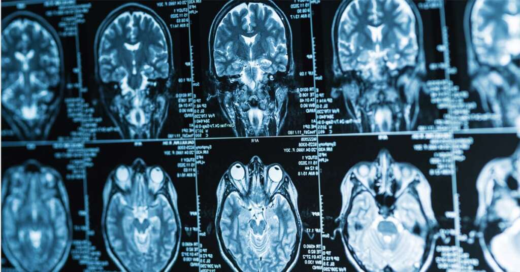 Connecticut Traumatic Brain Injury Lawyers